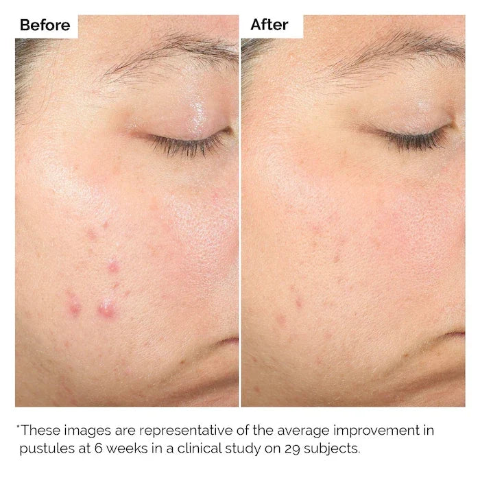 The Ordinary Salicylic Acid 2% Blemish Solution